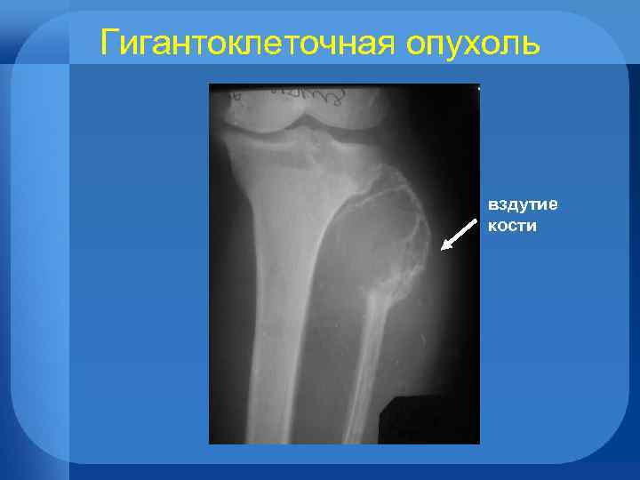 Гигантоклеточная опухоль вздутие кости 