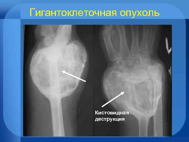 Опухоли лучевой кости. Гигантоклеточная опухоль большеберцовой кости. Гигантоклеточная опухоль бедренной кости рентген. Гигантоклеточная опухоль лучевой кости. Гигантоклеточная опухоль кости кт.