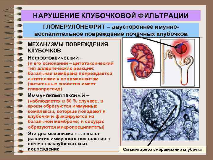 НАРУШЕНИЕ КЛУБОЧКОВОЙ ФИЛЬТРАЦИИ ГЛОМЕРУЛОНЕФРИТ – двустороннее имунновоспалительное повреждение почечных клубочков • МЕХАНИЗМЫ ПОВРЕЖДЕНИЯ КЛУБОЧКОВ