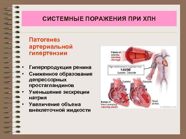 СИСТЕМНЫЕ ПОРАЖЕНИЯ ПРИ ХПН Патогенез артериальной гипертензии • Гиперпродукция ренина • Сниженное образование депрессорных