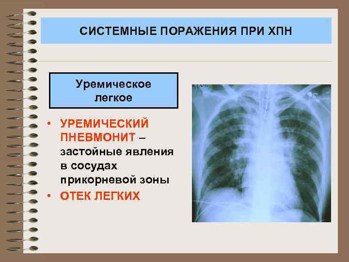 СИСТЕМНЫЕ ПОРАЖЕНИЯ ПРИ ХПН Уремическое легкое • УРЕМИЧЕСКИЙ ПНЕВМОНИТ – застойные явления в сосудах