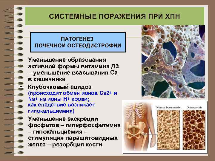 СИСТЕМНЫЕ ПОРАЖЕНИЯ ПРИ ХПН ПАТОГЕНЕЗ ПОЧЕЧНОЙ ОСТЕОДИСТРОФИИ • Уменьшение образования активной формы витамина Д