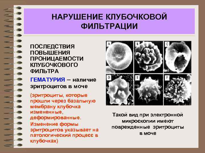 НАРУШЕНИЕ КЛУБОЧКОВОЙ ФИЛЬТРАЦИИ ПОСЛЕДСТВИЯ ПОВЫШЕНИЯ ПРОНИЦАЕМОСТИ КЛУБОЧКОВОГО ФИЛЬТРА ГЕМАТУРИЯ – наличие эритроцитов в моче