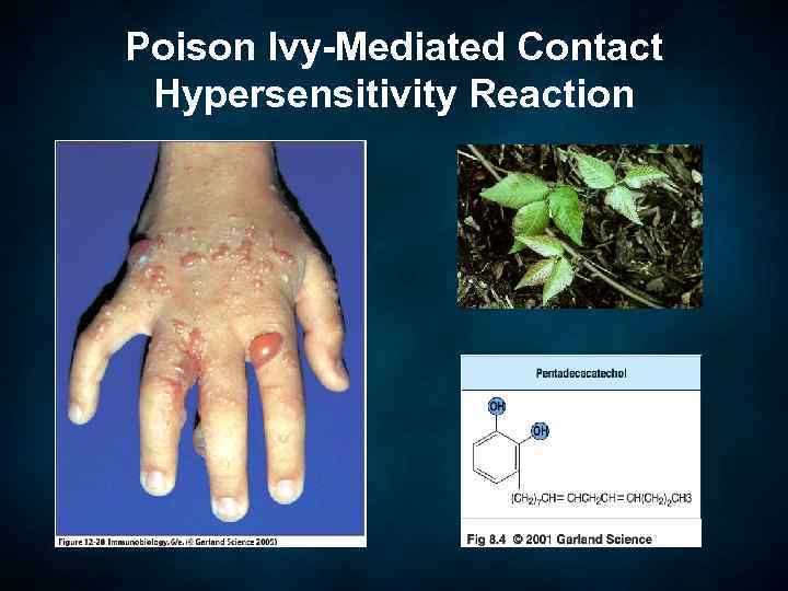 Poison Ivy-Mediated Contact Hypersensitivity Reaction 