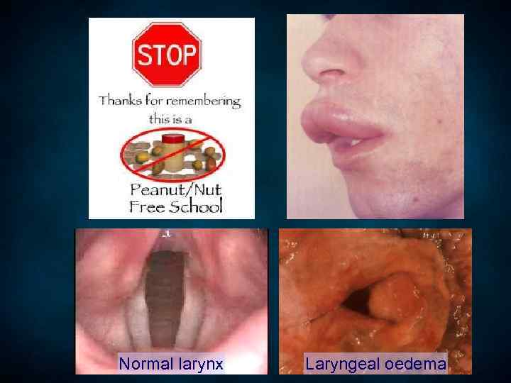 Normal larynx Laryngeal oedema 