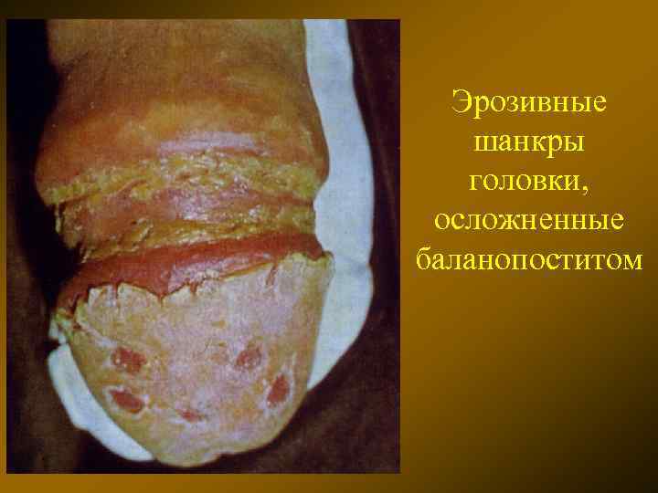 Эрозивные шанкры головки, осложненные баланопоститом 