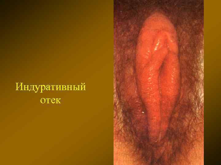 Индуративный отек 