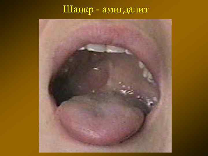 Шанкр - амигдалит 