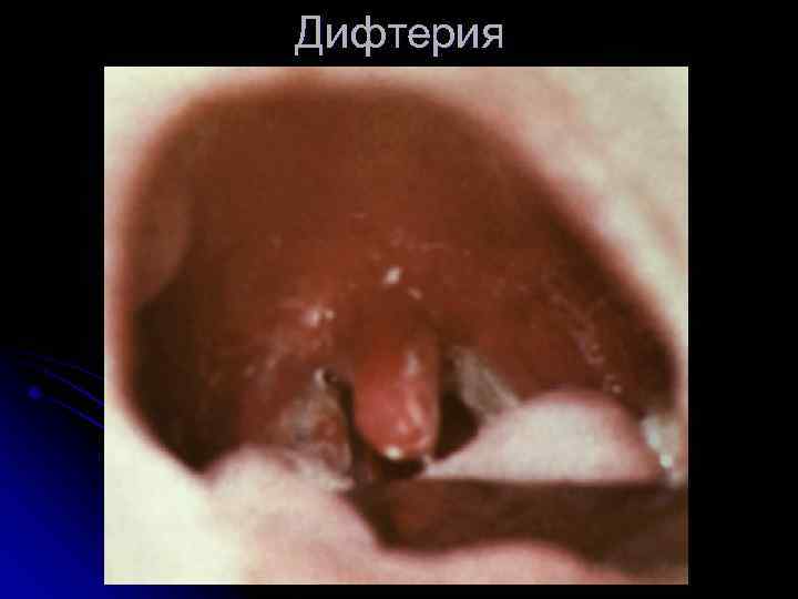 Дифтерия 