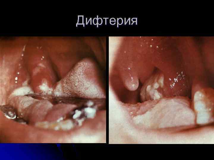 Дифтерия 