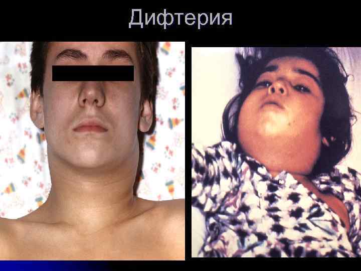 Дифтерия 
