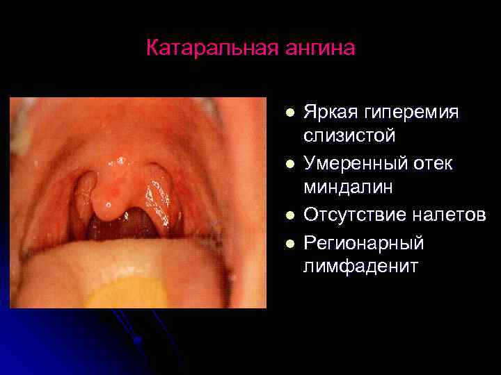 Катаральная ангина l l Яркая гиперемия слизистой Умеренный отек миндалин Отсутствие налетов Регионарный лимфаденит