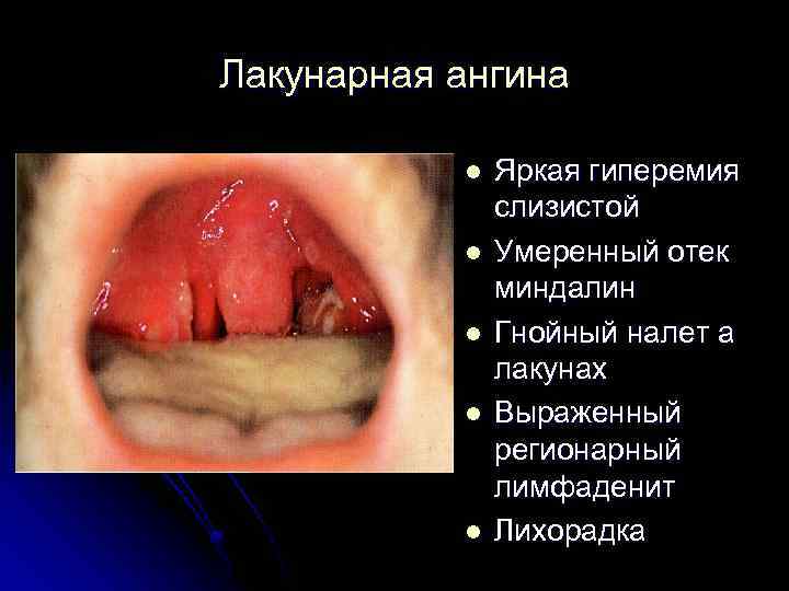 Лакунарная ангина l l l Яркая гиперемия слизистой Умеренный отек миндалин Гнойный налет а