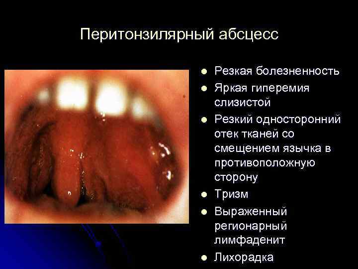 Перитонзилярный абсцесс l l l Резкая болезненность Яркая гиперемия слизистой Резкий односторонний отек тканей