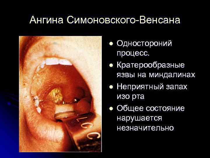 Ангина Симоновского-Венсана l l Одностороний процесс. Кратерообразные язвы на миндалинах Неприятный запах изо рта