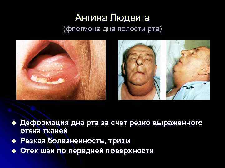 Ангина Людвига (флегмона дна полости рта) l l l Деформация дна рта за счет