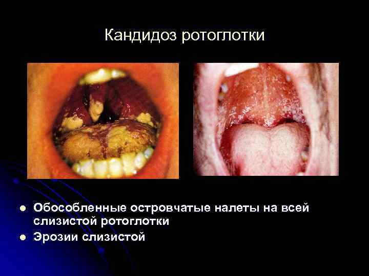 Кандидоз ротоглотки l l Обособленные островчатые налеты на всей слизистой ротоглотки Эрозии слизистой 