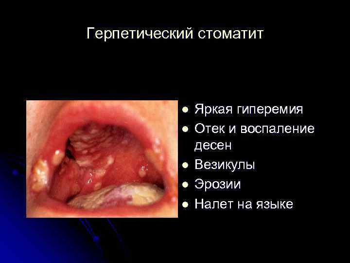 Герпетический стоматит l l l Яркая гиперемия Отек и воспаление десен Везикулы Эрозии Налет