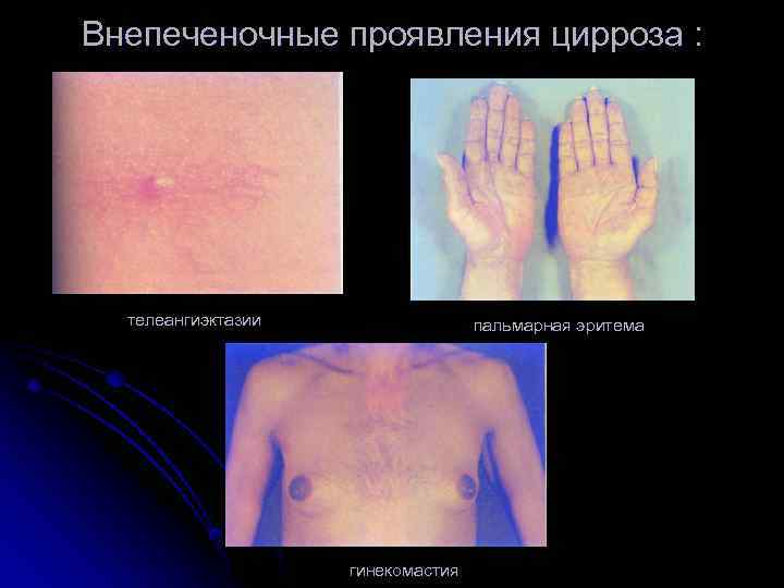 Внепеченочные проявления цирроза : телеангиэктазии пальмарная эритема гинекомастия 
