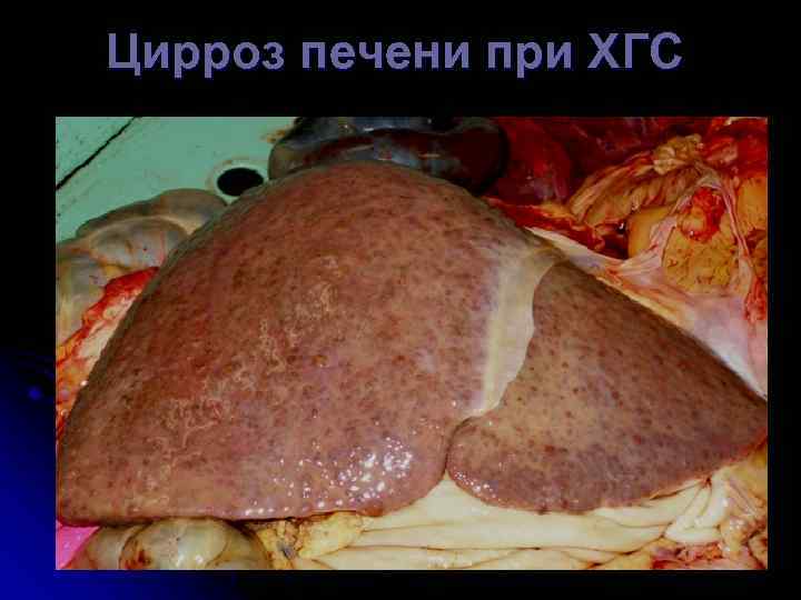 Цирроз печени при ХГС 