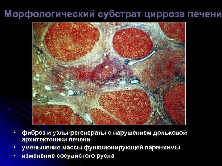 Морфологический субстрат цирроза печени • фиброз и узлы-регенераты с нарушением дольковой архитектоники печени •