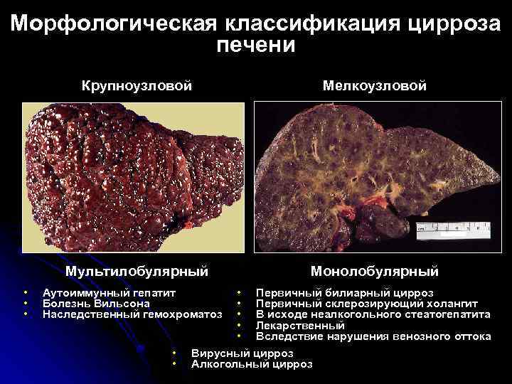Морфологическая классификация цирроза печени Крупноузловой Мультилобулярный • • • Мелкоузловой Монолобулярный • Первичный билиарный