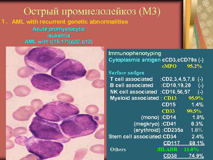 Острый промиелолейкоз (М 3) １．AML with recurrent genetic abnormalities Acute promyelocytic leukemia AML with