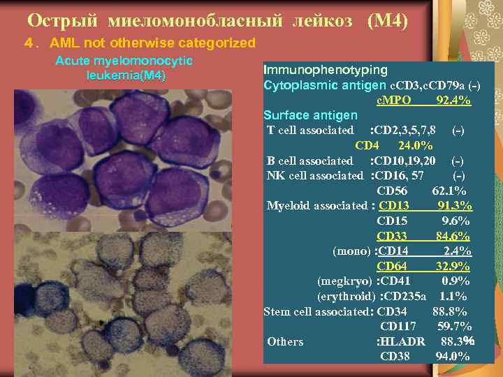 Острый миеломонобласный лейкоз (М 4) ４．AML not otherwise categorized Acute myelomonocytic leukemia(M 4) Immunophenotyping