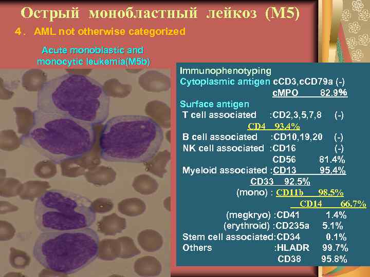 Острый монобластный лейкоз (М 5) ４．AML not otherwise categorized Acute monoblastic and monocytic leukemia(M