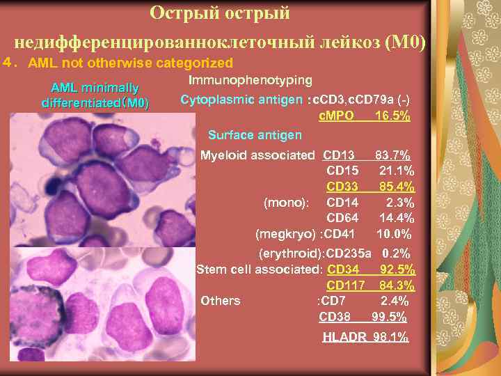 Острый острый недифференцированноклеточный лейкоз (М 0) ４．AML not otherwise categorized AML minimally differentiated（M 0)