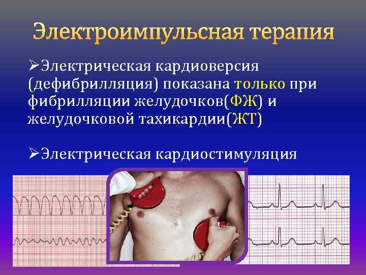 Дефибрилляция и кардиоверсия. Кардиоверсия и Электроимпульсная терапия. Электроимпульсная терапия:дефибрилляция и кардиоверсия. Электроимпульсная терапия (ЭИТ).