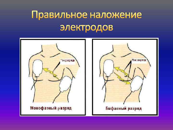 Правильное наложение электродов 