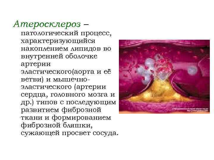 Атеросклероз – патологический процесс, характеризующийся накоплением липидов во внутренней оболочке артерии эластического(аорта и её