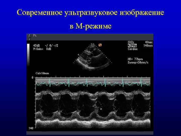 Современное ультразвуковое изображение в М-режиме 