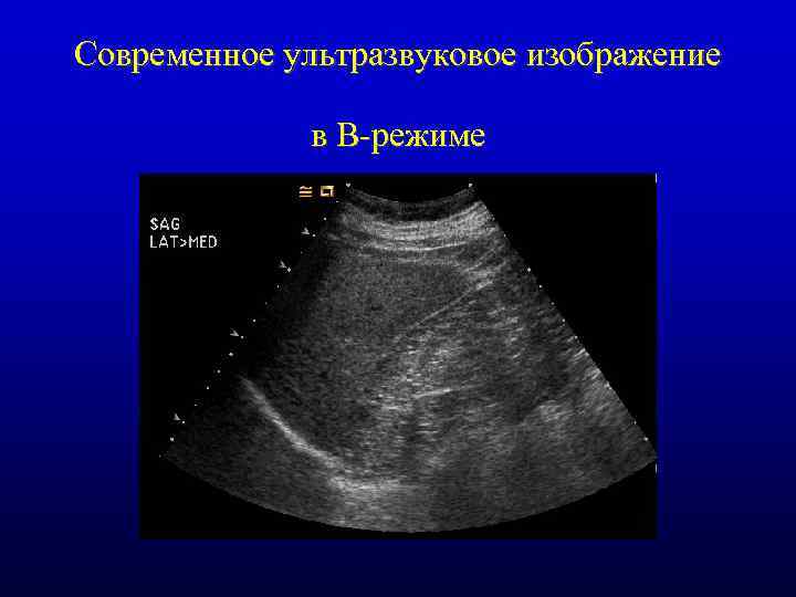 Современное ультразвуковое изображение в В-режиме 