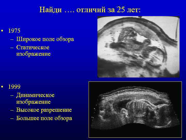 Найди …. отличий за 25 лет: • 1975 – Широкое поле обзора – Статическое