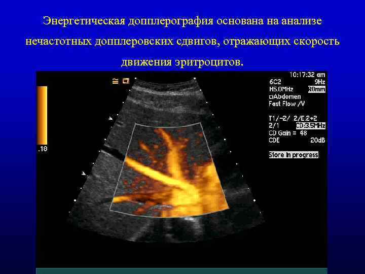 Энергетическая допплерография основана на анализе нечастотных допплеровских сдвигов, отражающих скорость движения эритроцитов. 