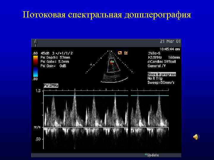 Потоковая спектральная допплерография 