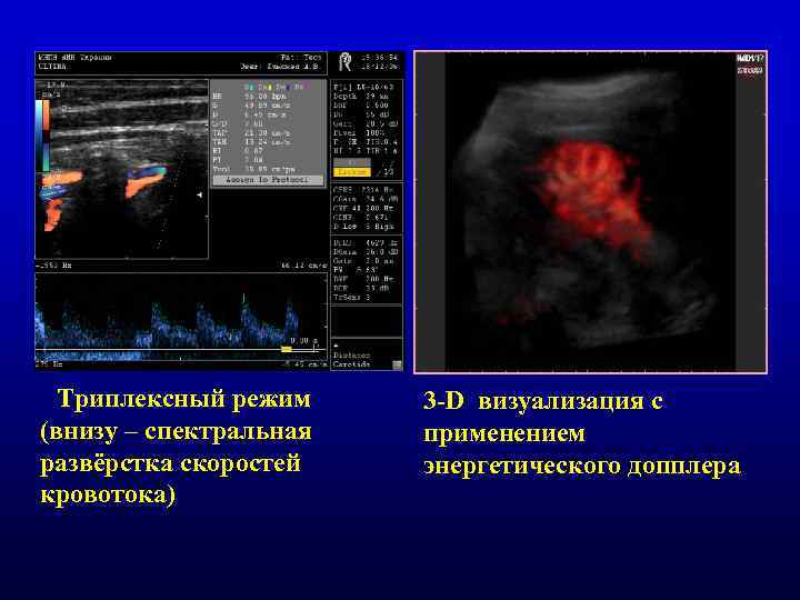 Триплексный режим (внизу – спектральная развёрстка скоростей кровотока) 3 -D визуализация с применением энергетического