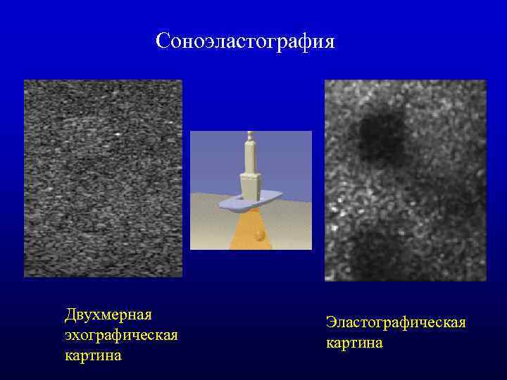 Соноэластография Двухмерная эхографическая картина Эластографическая картина 