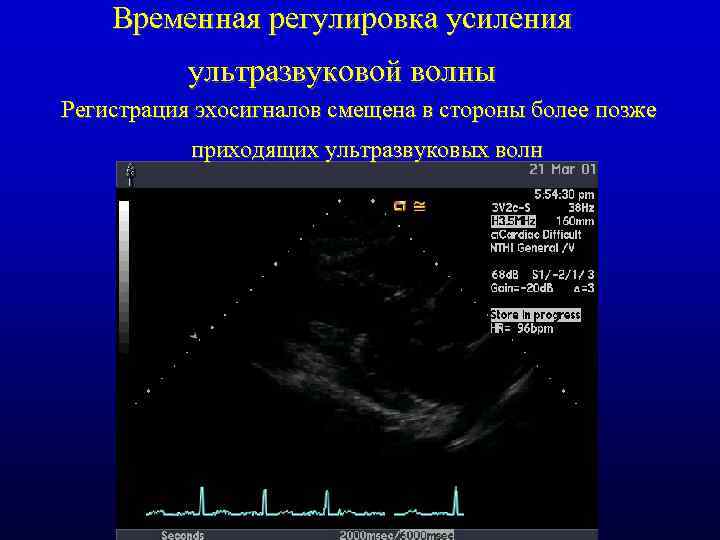 Временная регулировка усиления ультразвуковой волны Регистрация эхосигналов смещена в стороны более позже приходящих ультразвуковых