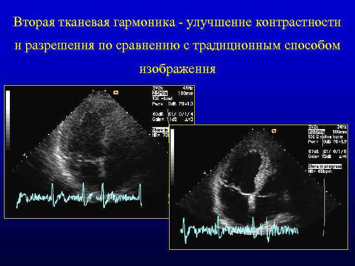 Вторая тканевая гармоника - улучшение контрастности и разрешения по сравнению с традиционным способом изображения