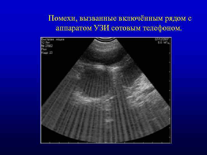  Помехи, вызванные включённым рядом с аппаратом УЗИ сотовым телефоном. 