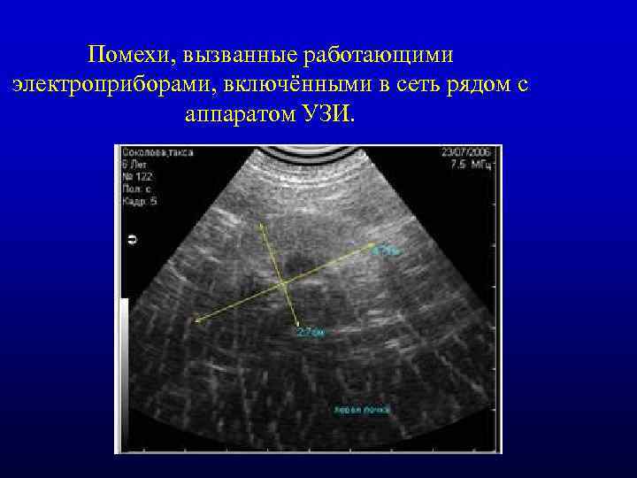 Помехи, вызванные работающими электроприборами, включёнными в сеть рядом с аппаратом УЗИ. 