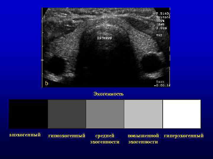 b Эхогенность анэхогенный гипоэхогенный средней эхогенности повышенной гиперэхогенный эхогенности 