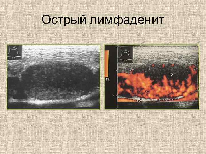 Острый лимфаденит 