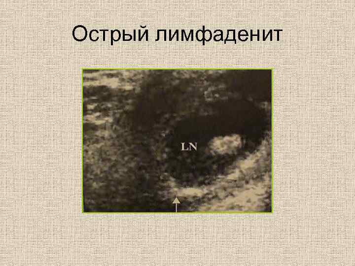 Острый лимфаденит 