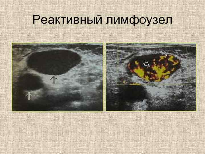 Реактивный лимфоузел 