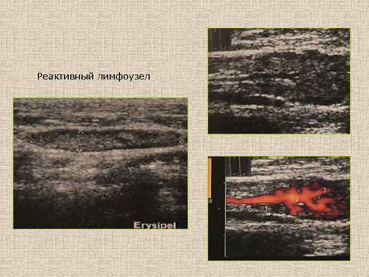 Реактивный лимфоузел 