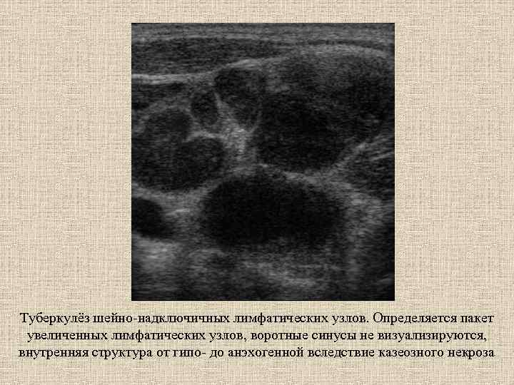 Туберкулёз шейно-надключичных лимфатических узлов. Определяется пакет увеличенных лимфатических узлов, воротные синусы не визуализируются, внутренняя